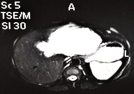 胆道囊腺瘤 肝脏的罕见囊性肿瘤 胆道囊腺瘤 肝脏的罕见囊性肿瘤